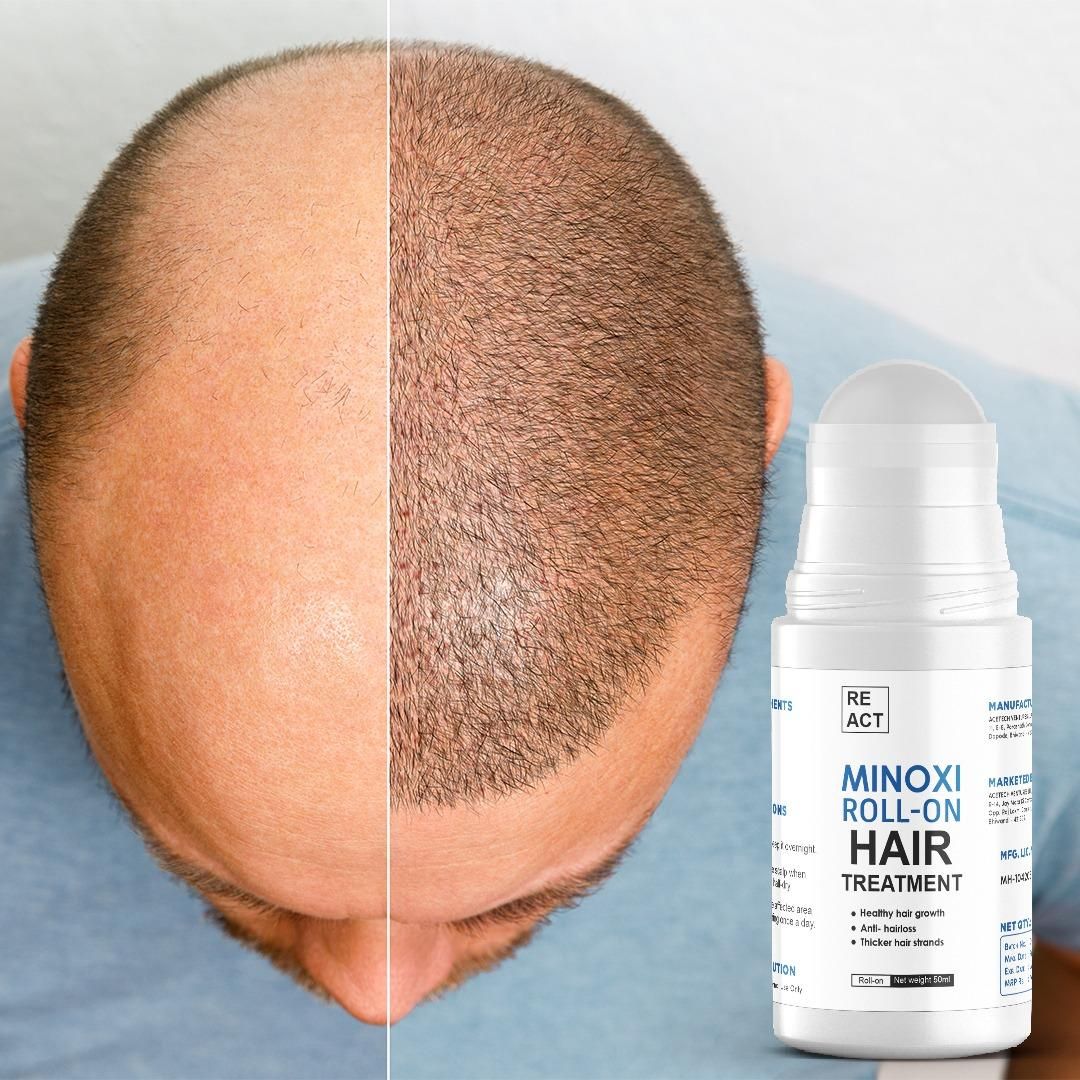 Minoxi Roll-On Hair Treatment Hair Growth Oil For Women & Men