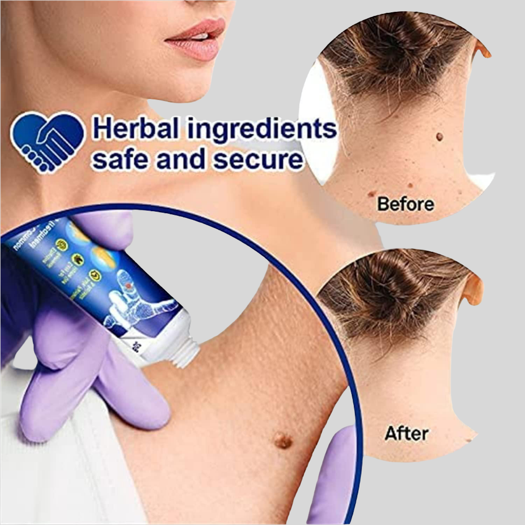 WartsOff Instant Blemish Removal Cream Pack of 2